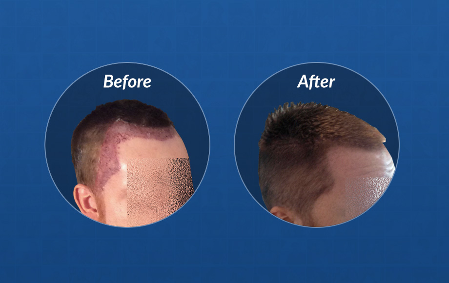 regrow hair after laser